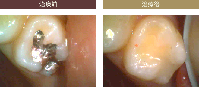 ダイレクトボンディング症例2　奥歯